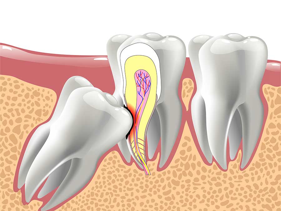 Signs of Impacted Wisdom Teeth